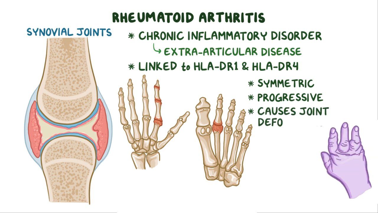 Arthritis