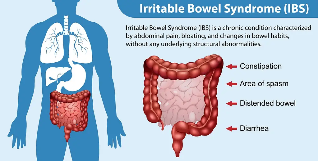 natural remedies for IBS