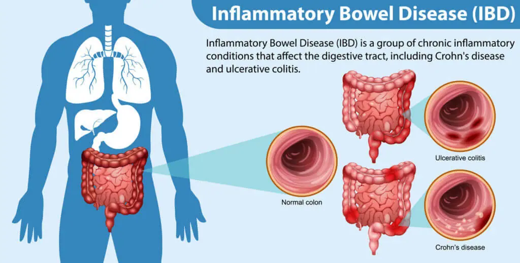  inflammatory bowel disease India