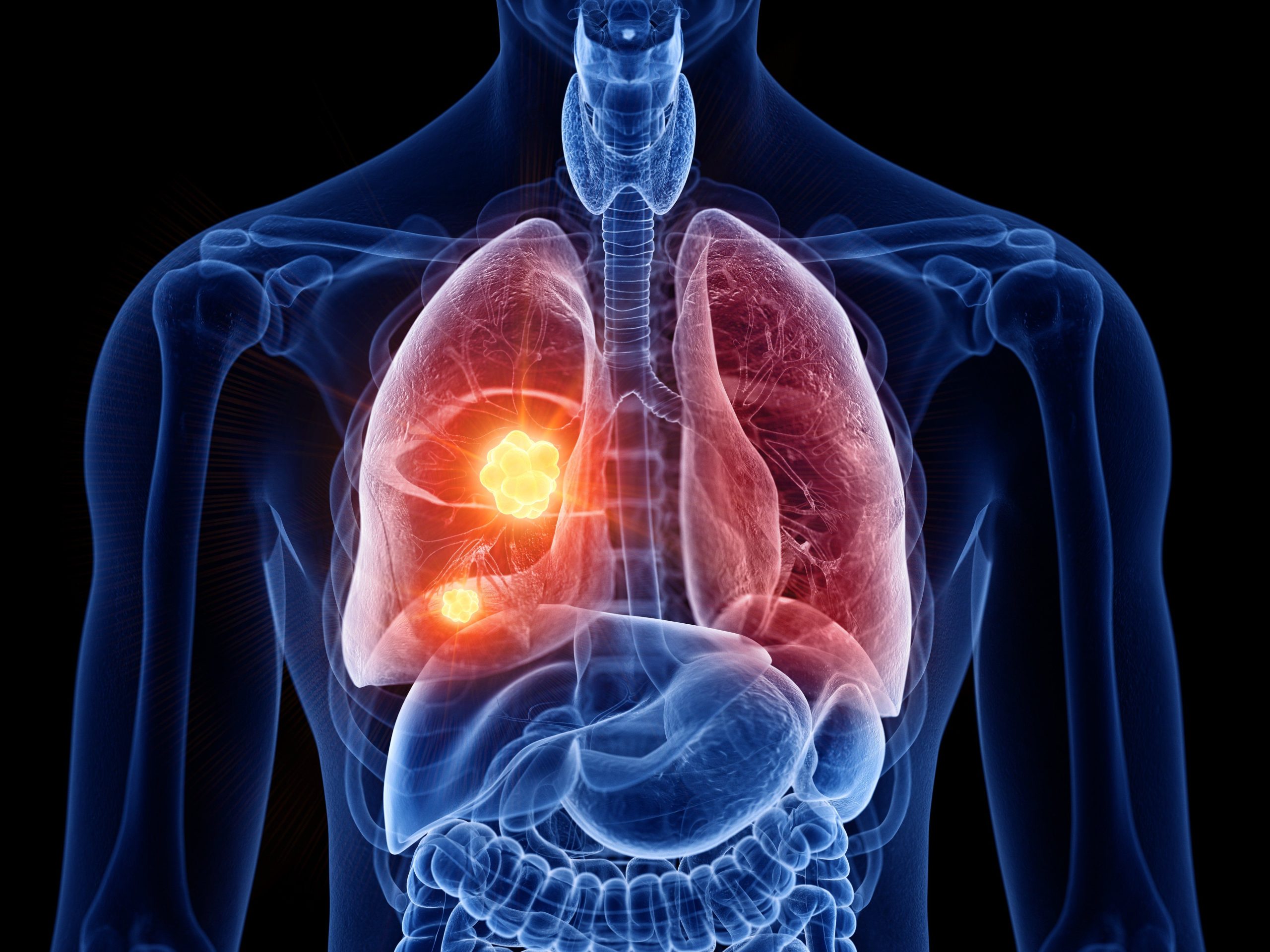 Lung Cancer Warning Signs