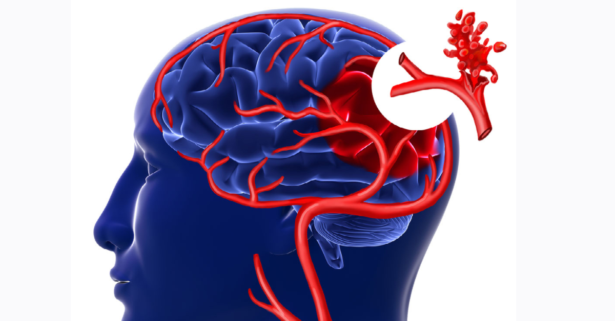 Brain Aneurysm