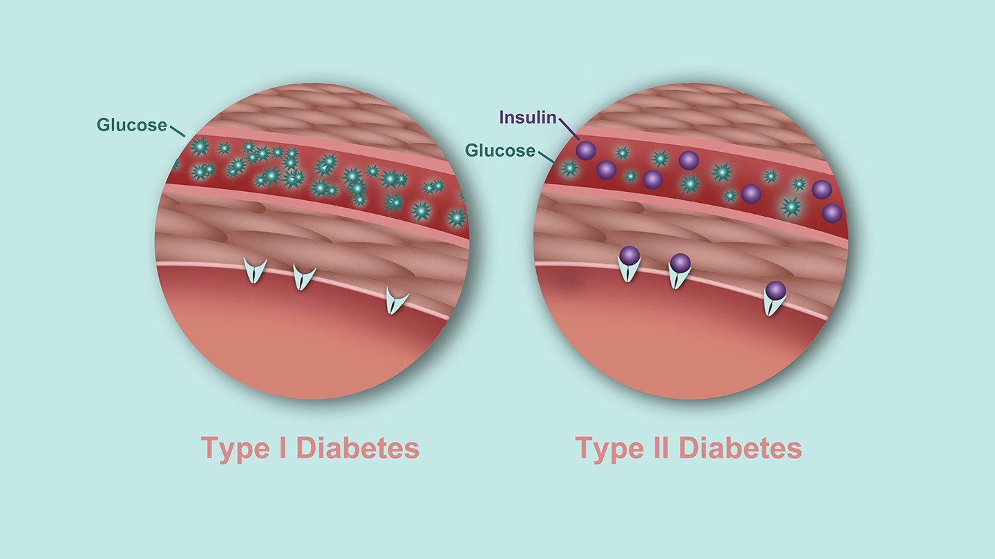 Diabetes Symptoms