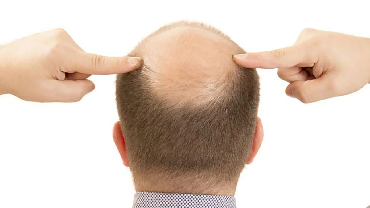hair loss causes