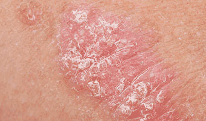 psoriasis