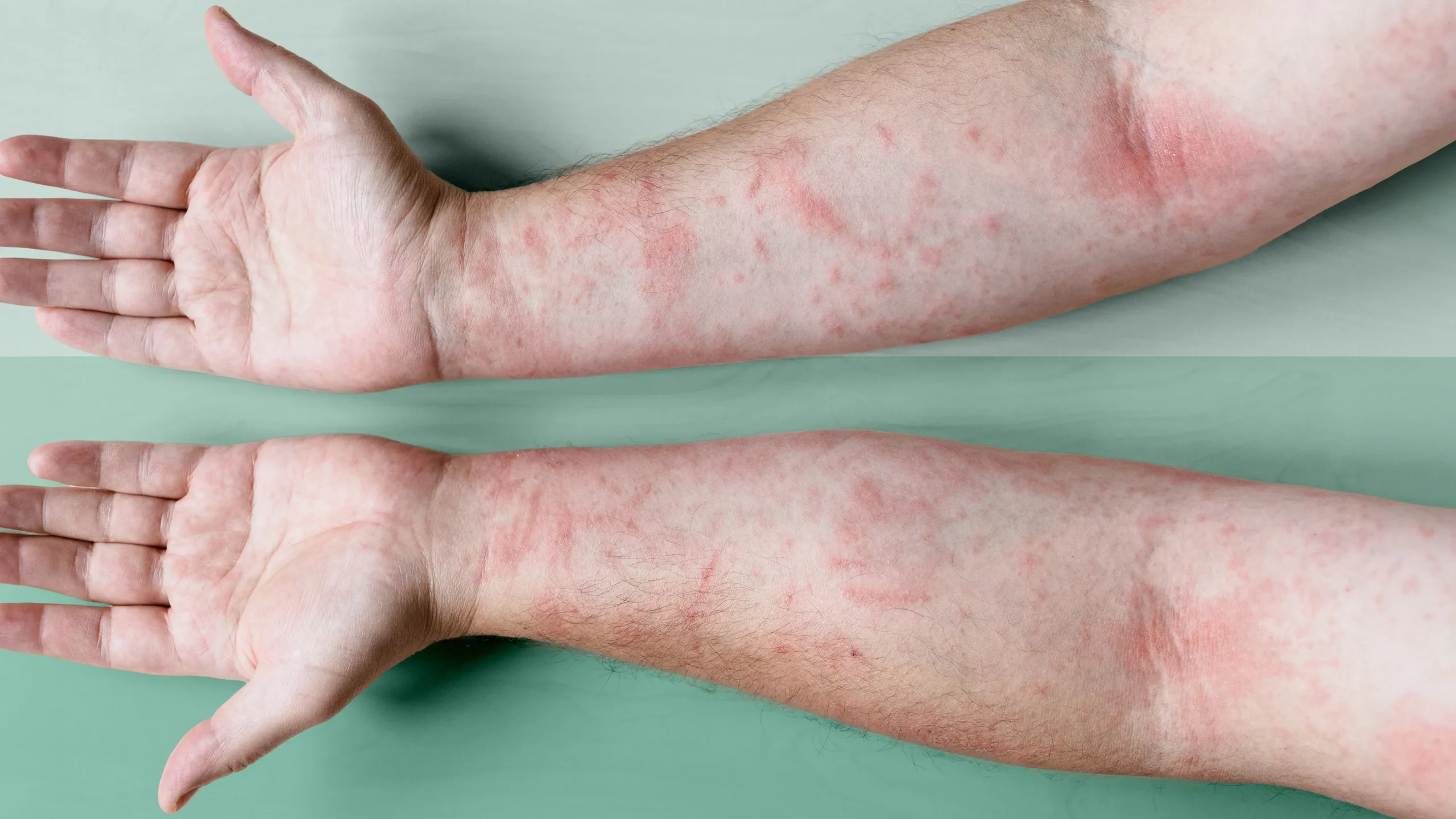Dermatitis