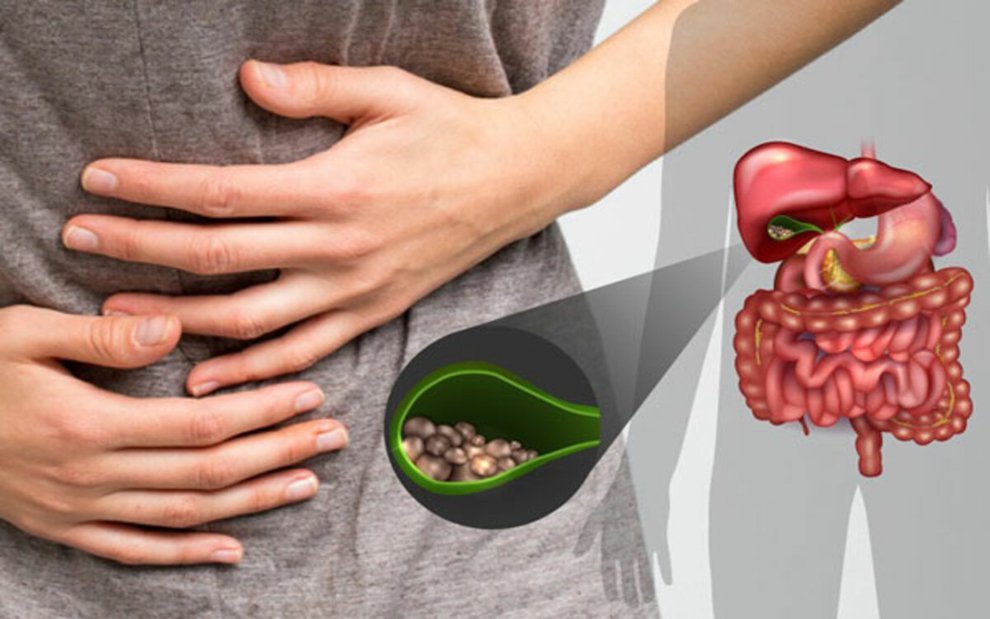 gallstone treatment